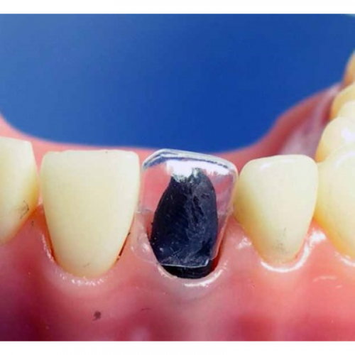 Матрицы контурные лавсановые закрытые для детских зубов № 1.912 (Колпачки)
